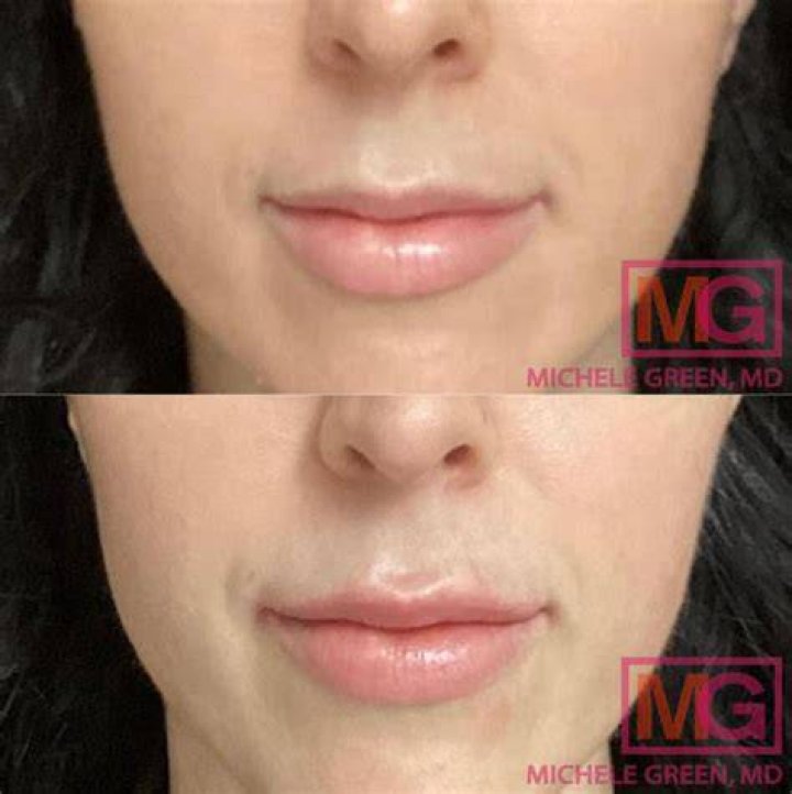Ines Helene Before Plastic Surgery | Botox And Lip Filler