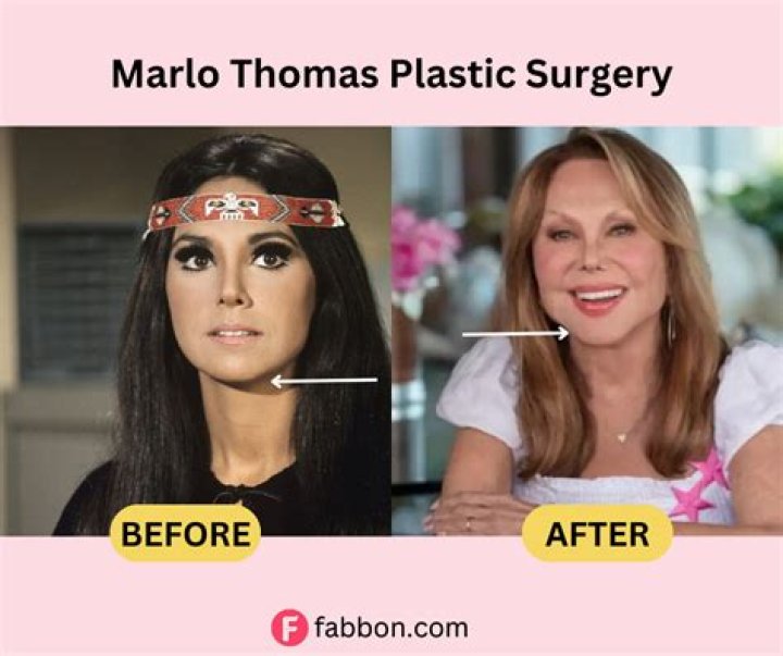 Marlo Thomas Plastic Surgery: What Happened To Her Face?