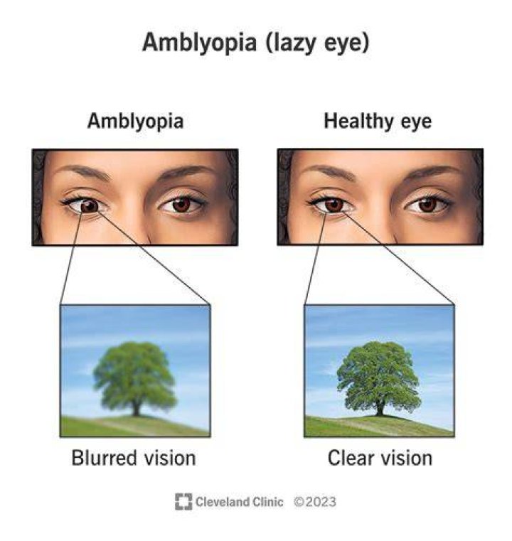 Mike Vrabel Eye Injury – Does He Have Amblyopia?