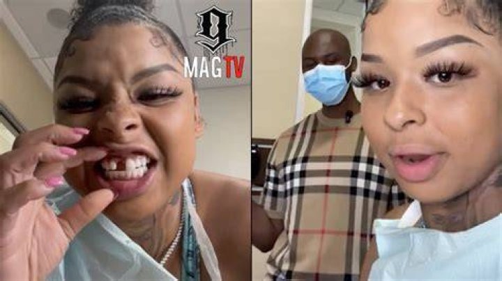 What Happened To Chrisean Rock’s Tooth? Everything To Know About The Rapper