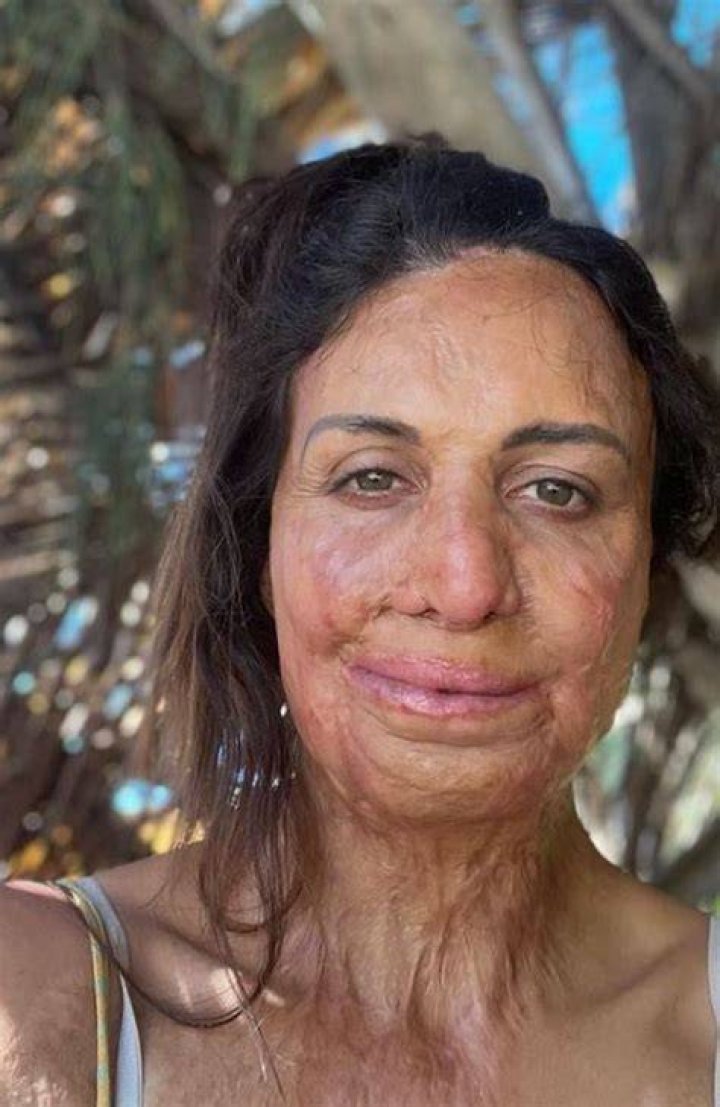 
What Happened To Turia Pitt? Accident Details And Before Photos – How Did She Get Burnt? 